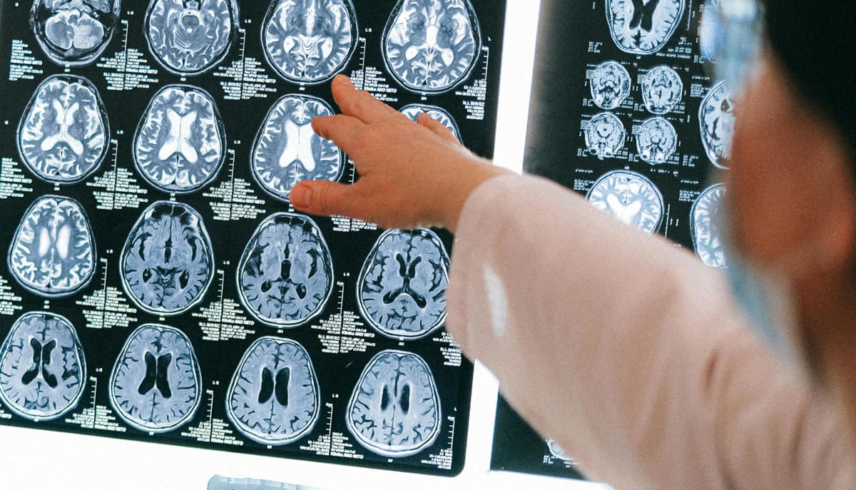 USP identifica sinal precoce de danos cerebrais após radioterapia em pacientes com câncer