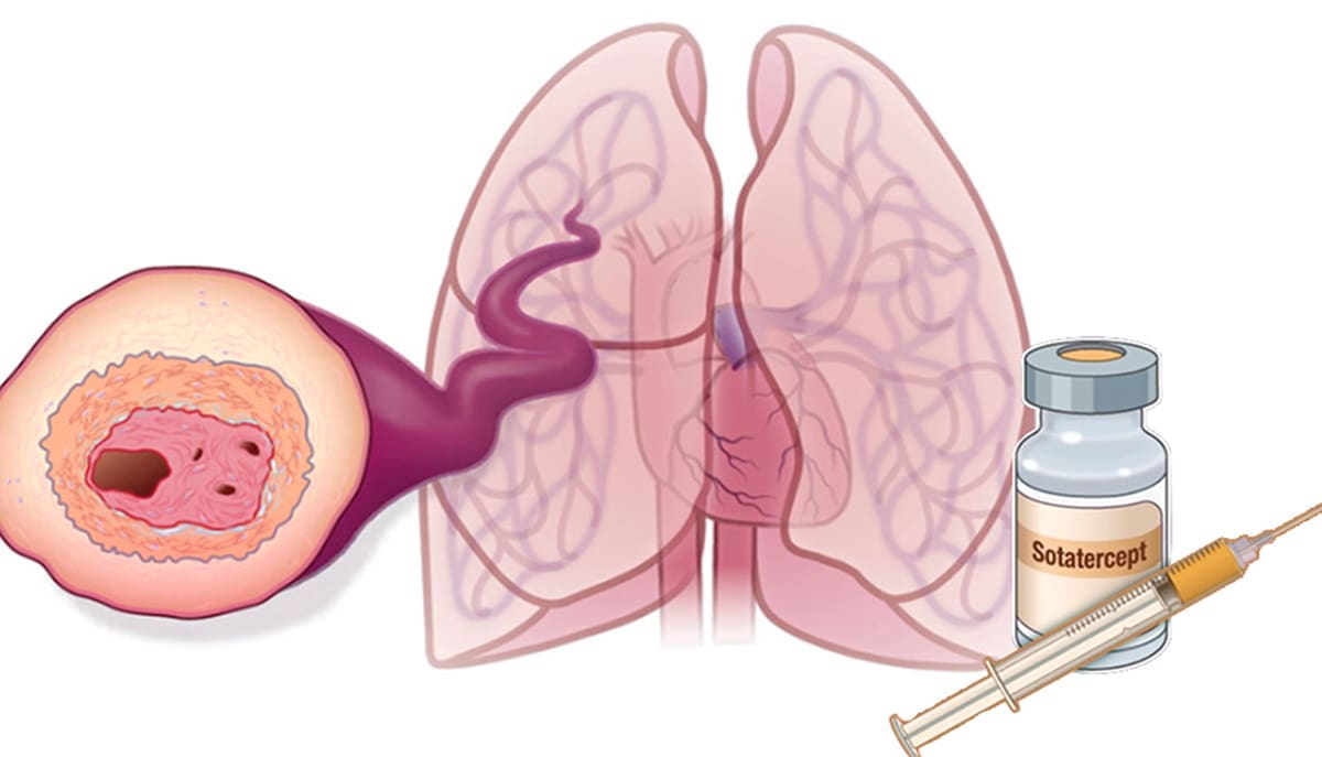 Pacientes com hipertensão arterial pulmonar podem se beneficiar do novo medicamento sotatercept